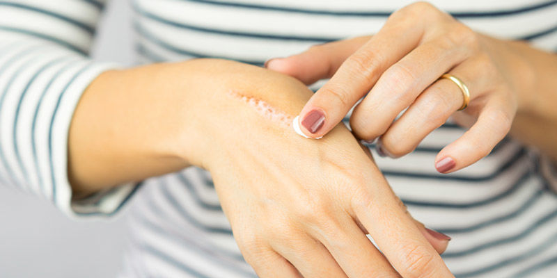 Nach Dem Nagel Greifen Und Sich Die Finger Verbrennen Nach Dem Nagel Greifen Und Sich Die Finger Verbrennen