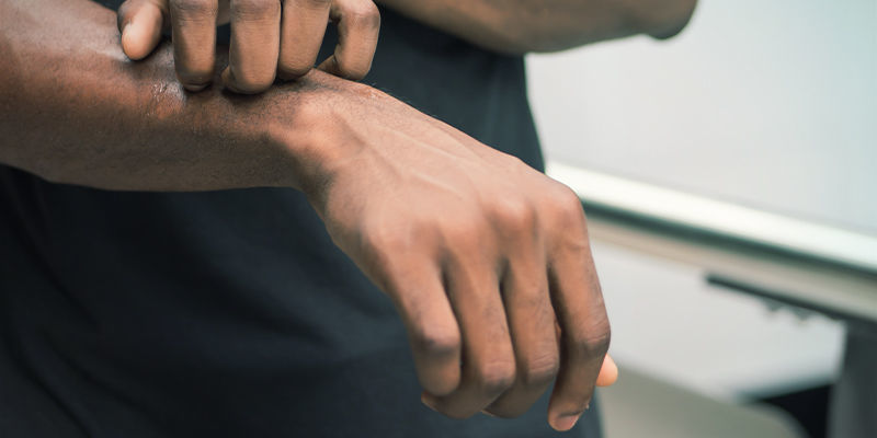 Symptome Einer Cannabisallergie Symptome Einer Cannabisallergie