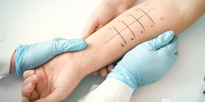 Eine Cannabisallergie Diagnostizieren Eine Cannabisallergie Diagnostizieren