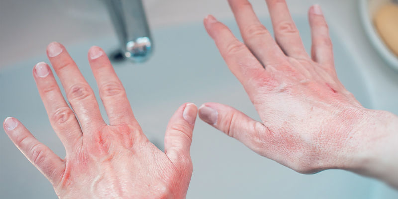 Wie Kann Man Verbrennungen Durch Chilis Auf Der Haut Stoppen? Wie Kann Man Verbrennungen Durch Chilis Auf Der Haut Stoppen?