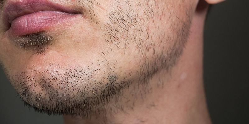 Cannabinoide, Testosteronspiegel Und Haarwachstum Cannabinoide, Testosteronspiegel Und Haarwachstum