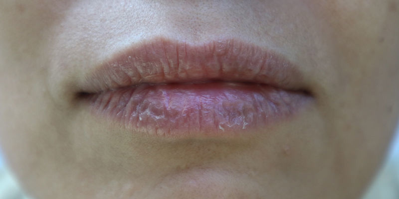 Mögliche Nebenwirkungen Von Kratom Mögliche Nebenwirkungen Von Kratom