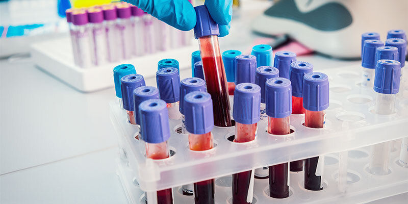 Haar- Und Blut-Drogentests Haar- und Blut-Drogentests