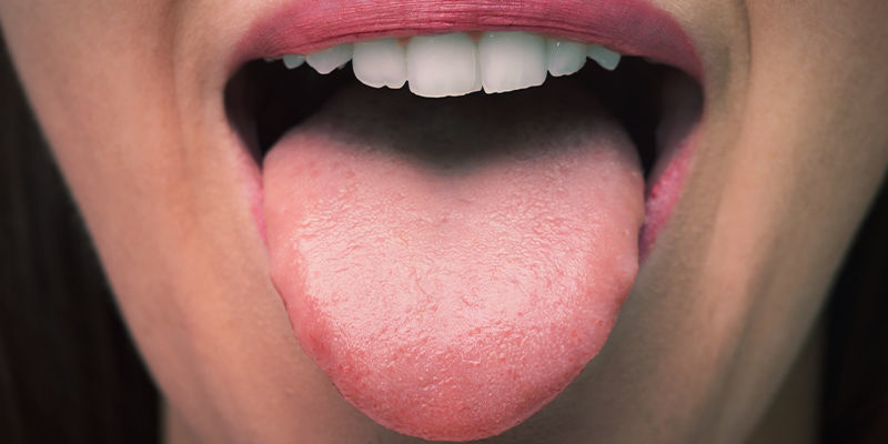 Mundtrockenheit Mundtrockenheit