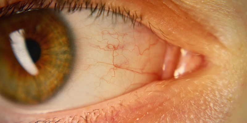 Rote Oder Blutunterlaufene Augen Rote Oder Blutunterlaufene Augen